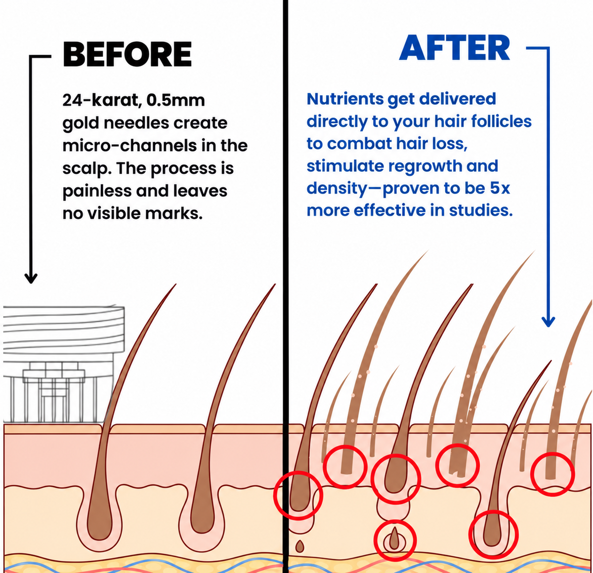 Accelerated Hair Growth Bundle (Micro-infusion + Serum)