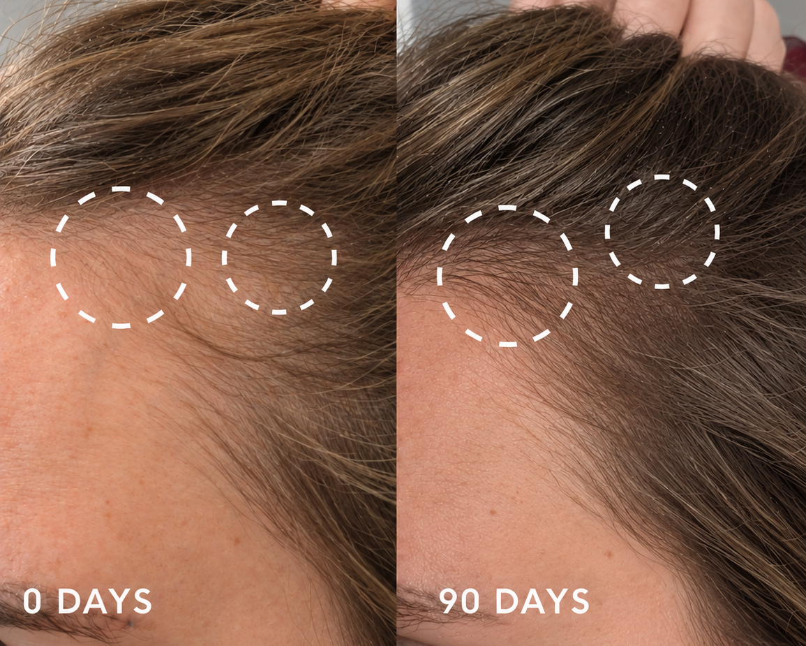 The Most Powerful Peptide Infusion Hair Regrowth System